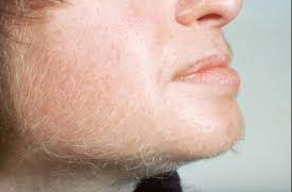 What Is The Difference Between Hypertrichosis And Hirsutism