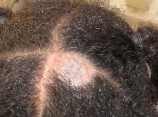 What Is The Difference Between Alopecia Areata And Tinea Capitis