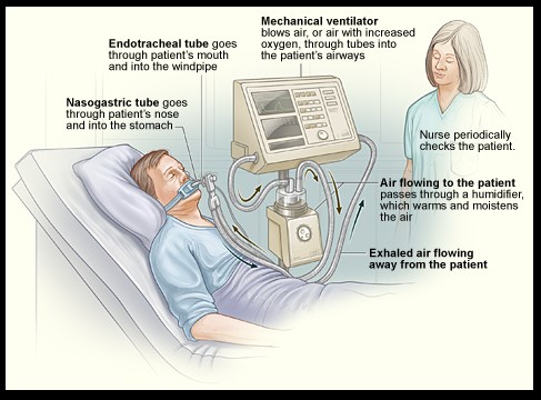 How respirators and ventilators work