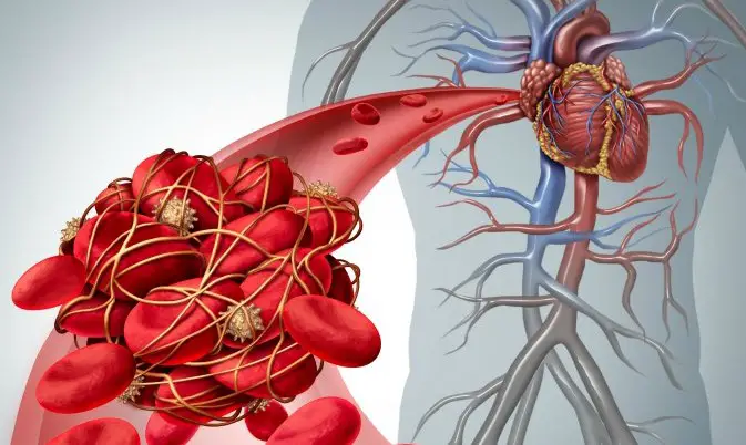 What is thrombosis