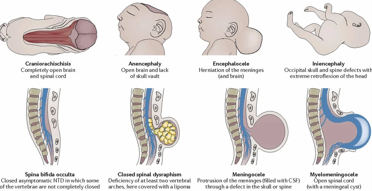 Difference Between Exencephaly And Anencephaly - Relationship Between