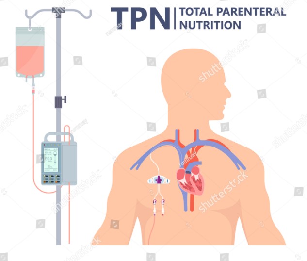 Difference Between Tpn And Tube Feeding