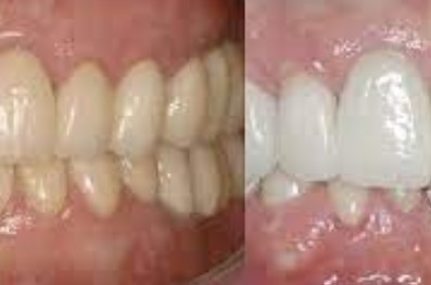 Difference Between Zirconia And Porcelain