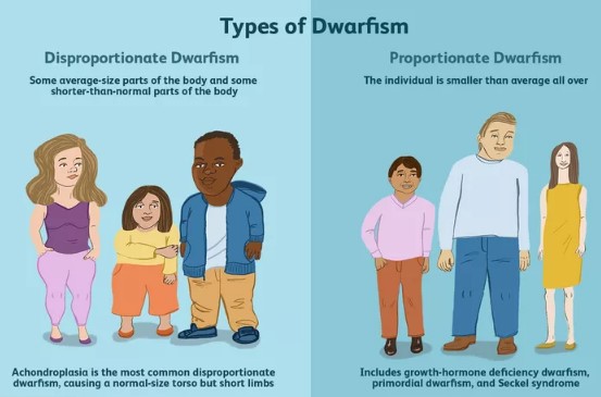 Physical differences between midgets and dwarves