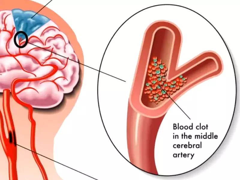 Difference Between Aneurysm And Vs Blood Clot