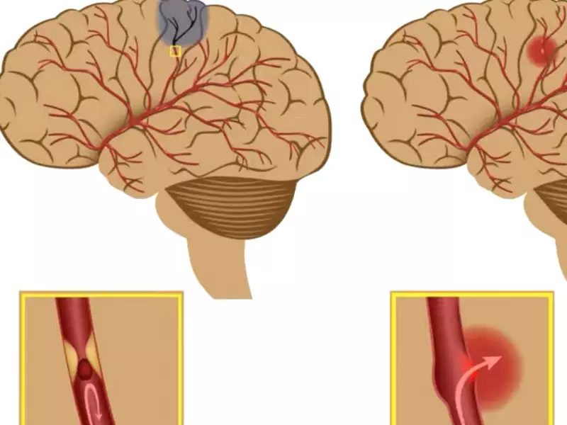 Difference Between Aneurysm And Vs Blood Clot