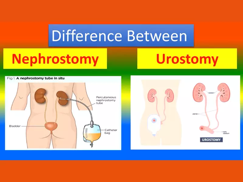 Difference Between Nephrostomy And Vs Urostomy
