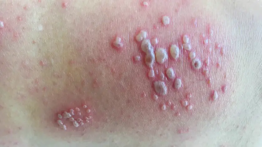 Difference Between Shingles And Vs Herpes