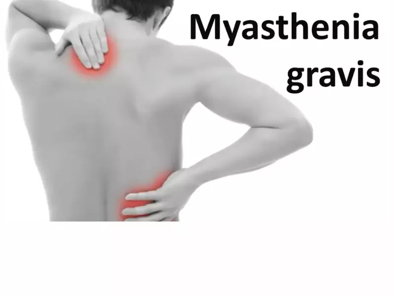 Relation Between Myasthenia Gravis And Thyroid Disease